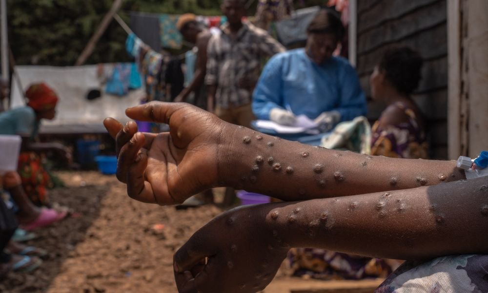 ONU prevê fim do surto de Mpox no Burundi com recursos e combate ao estigma